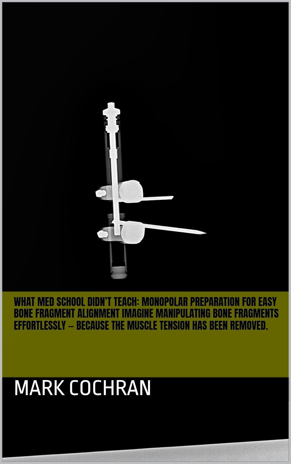 What Med School Didn’t Teach: Monopolar Preparation for Easy Bone Fragment Alignment Imagine manipulating bone fragments effortlessly — because the muscle tension has been removed. (English Edition) baixar o livro de graça