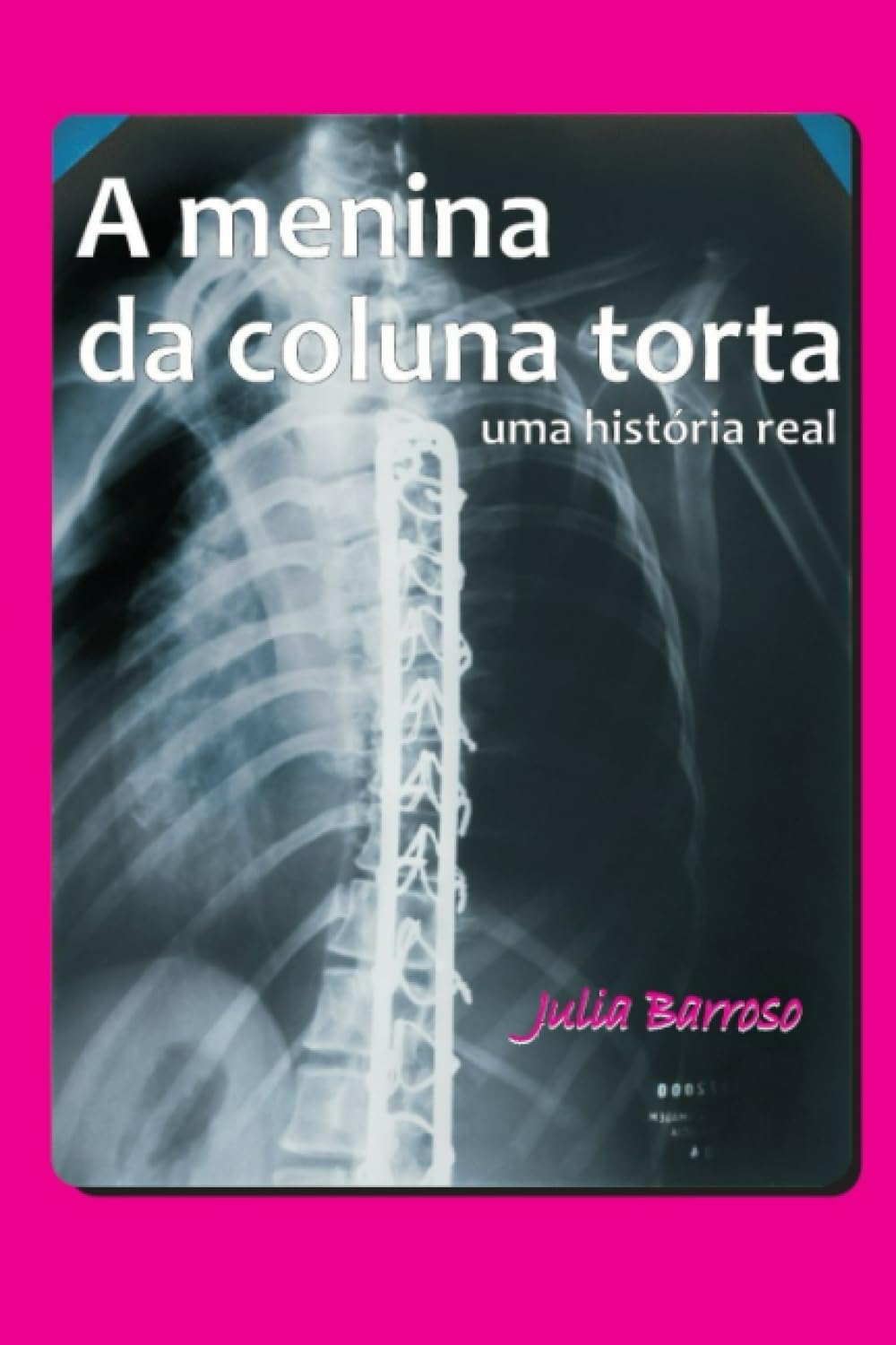 ler totalmente A Menina da Coluna Torta: Uma história real (Portuguese Edition)