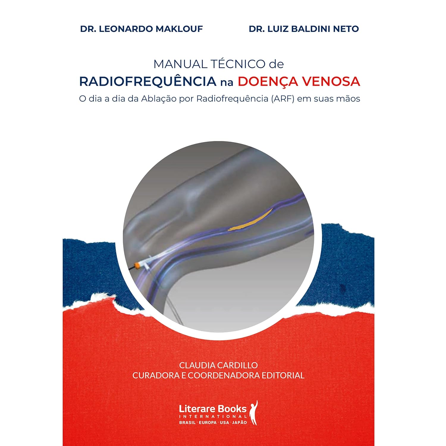 ler totalmente Manual técnico de radiofrequência na doença venosa: o dia a dia da ablação por radiofrequência (ARF) em suas mãos